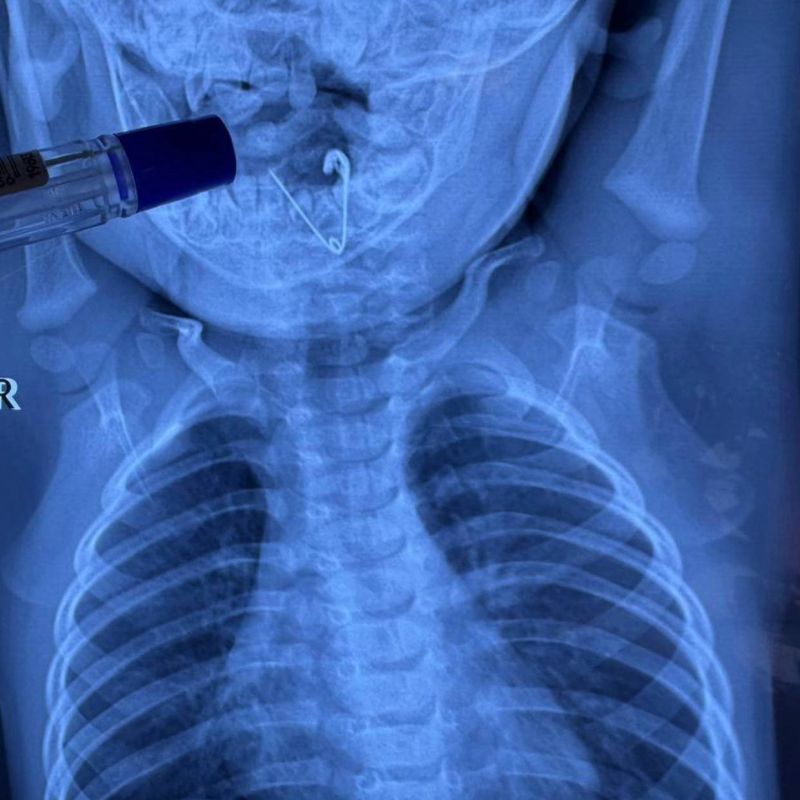 Приморские врачи спасли малыша, проглотившего булавку-оберег